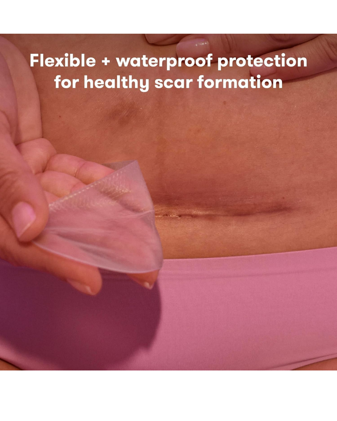 PARCHES DE SILICONA GRADO MEDICO PARA CICATRIZ DE CESAREA